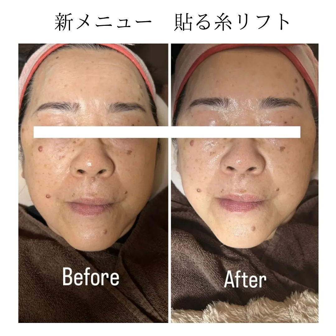 貼る糸リフト