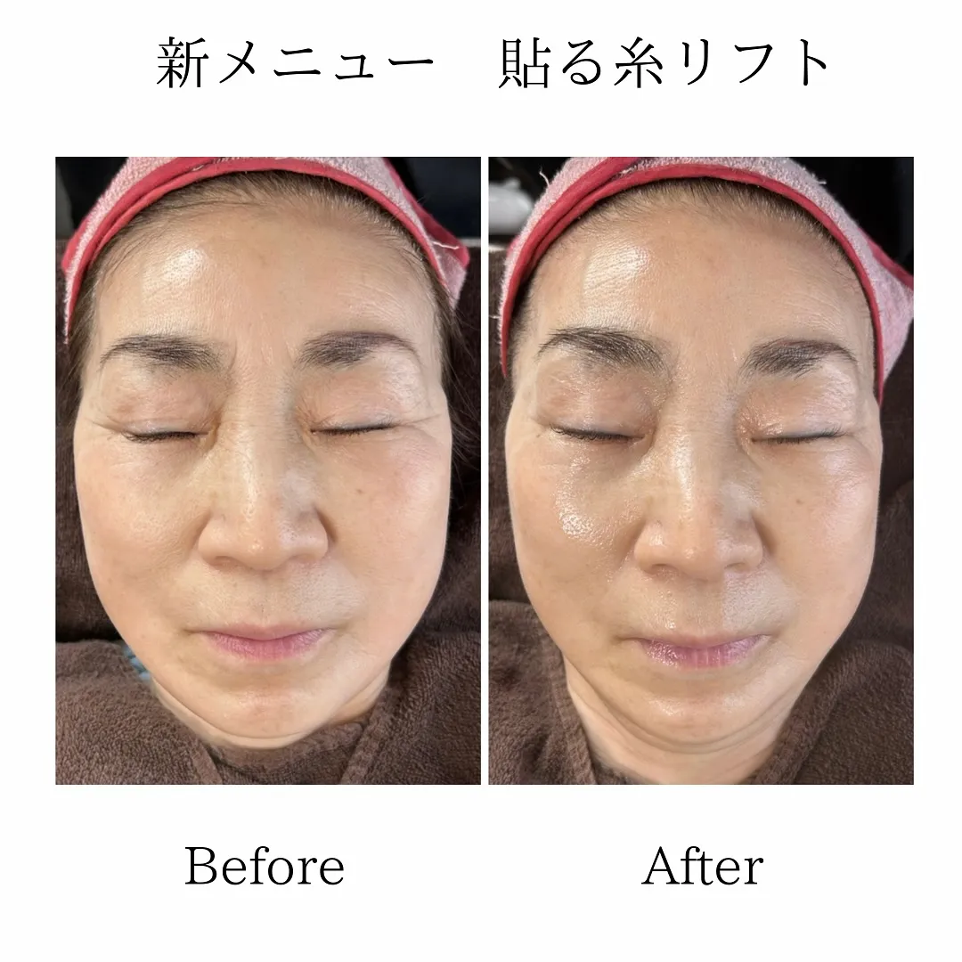🌹貼る糸リフト🌹