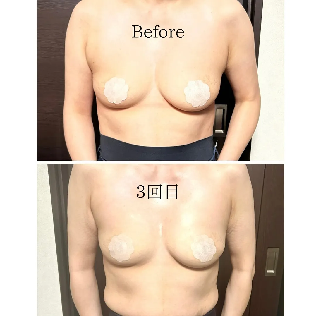 マシュマロバストケア3回の写真です✨