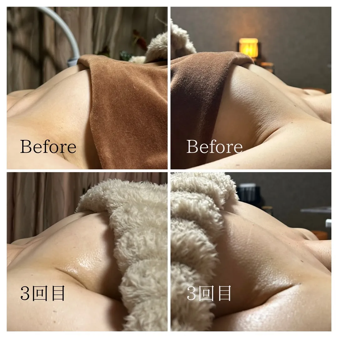 マシュマロバストケア3回の写真です✨