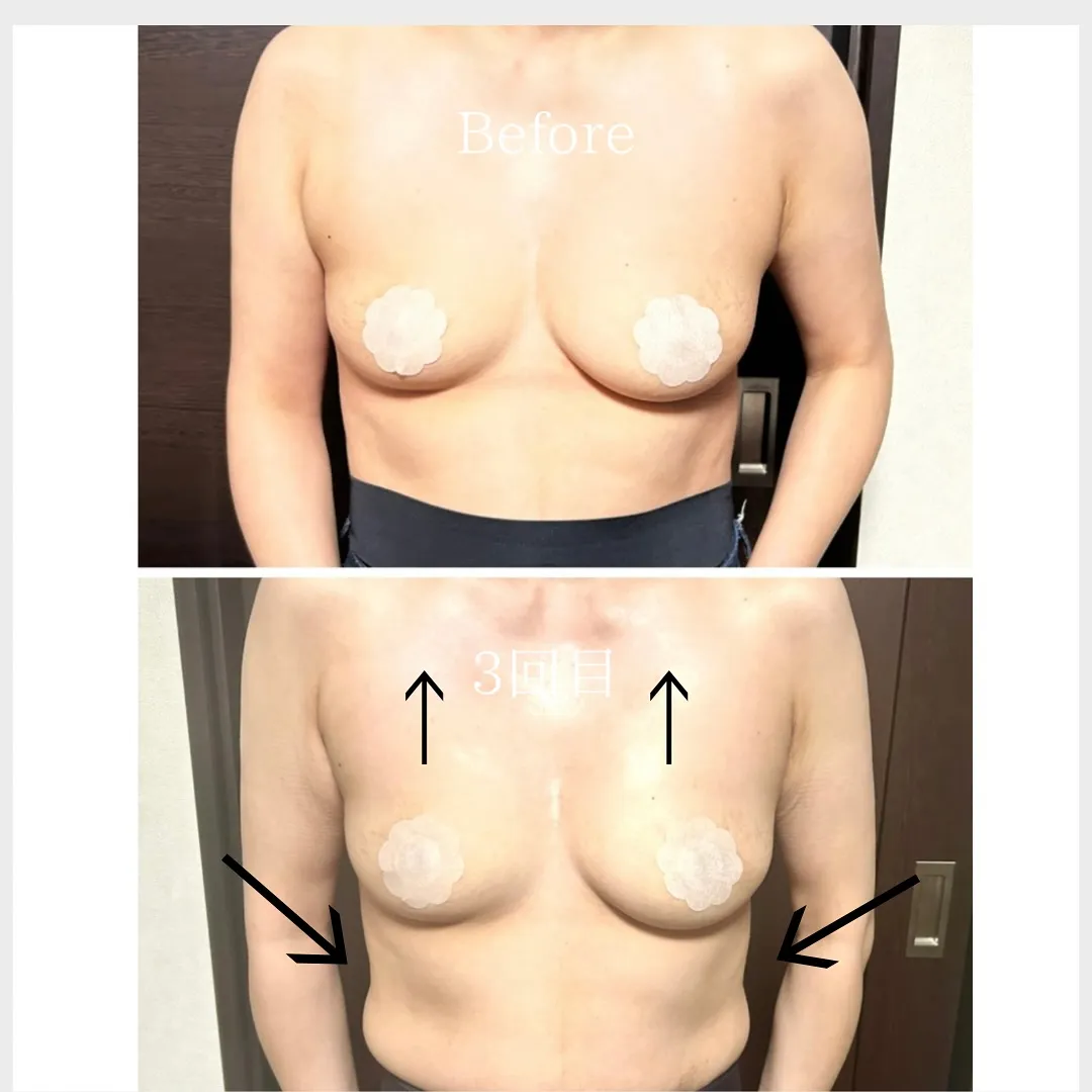 マシュマロバストケア3回の写真です✨