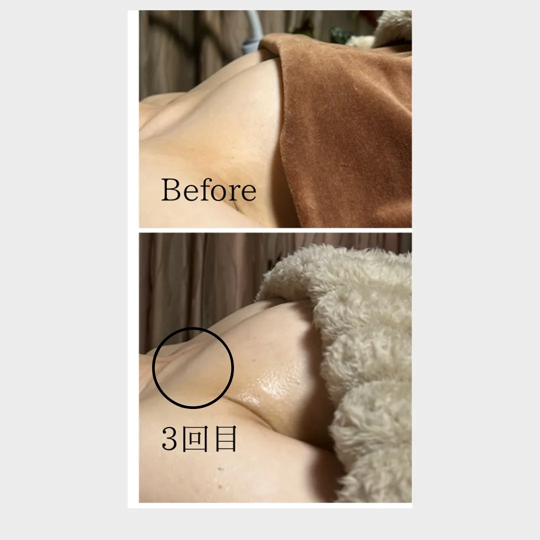 マシュマロバストケア3回の写真です✨