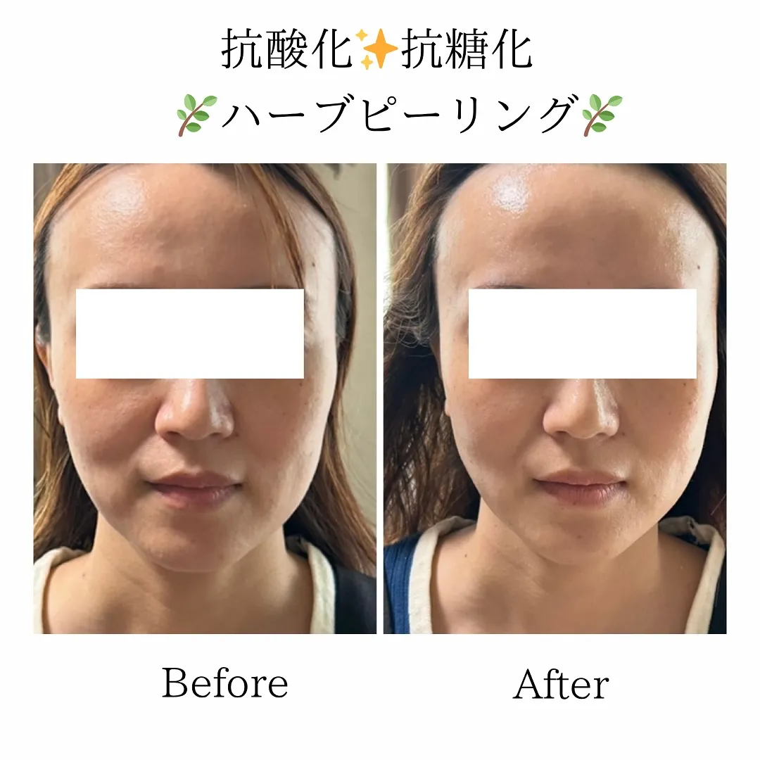 新メニューのハーブピーリング🌿