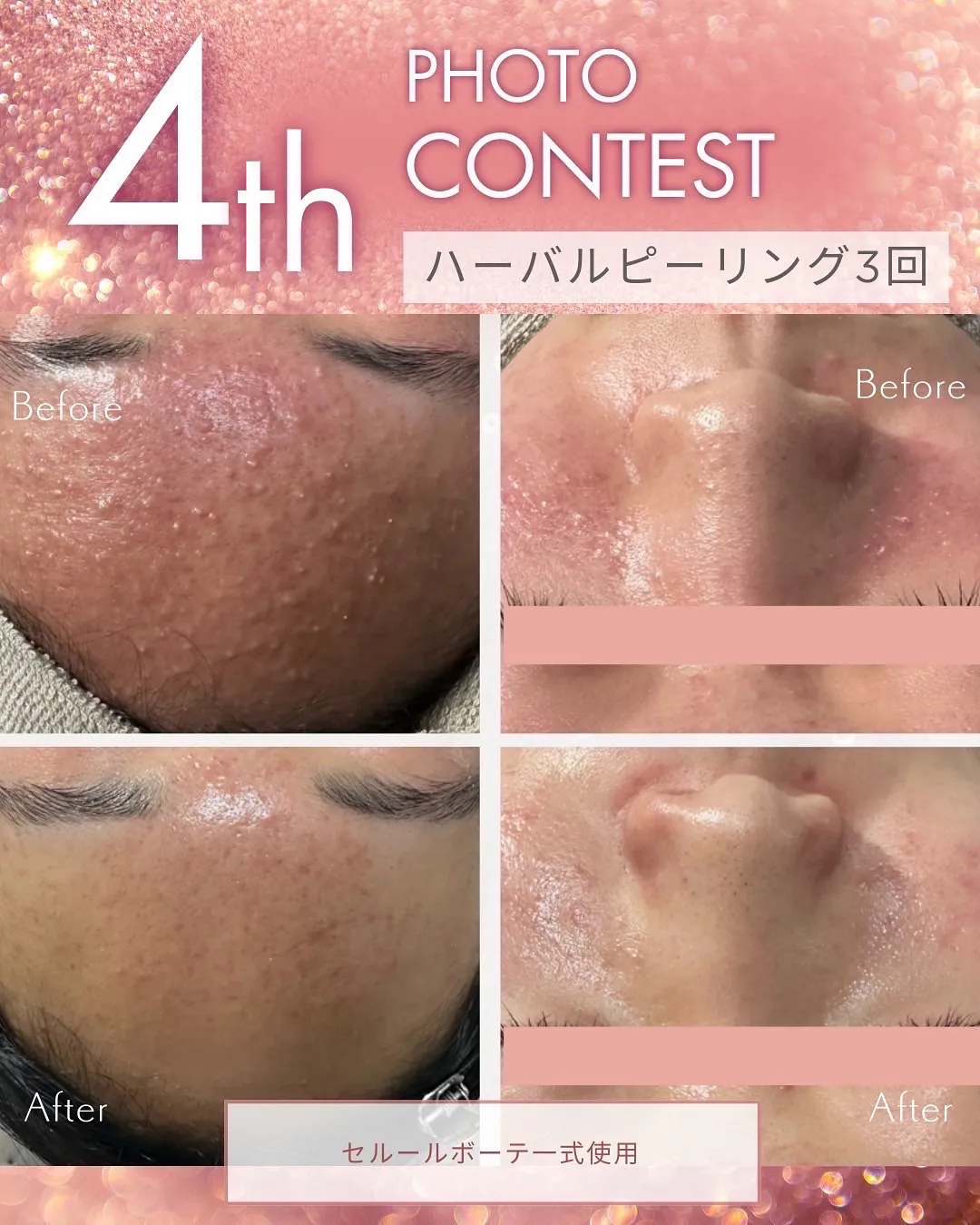 ハーバルピーリング（エンジェルではハーブピーリングと言ってま...