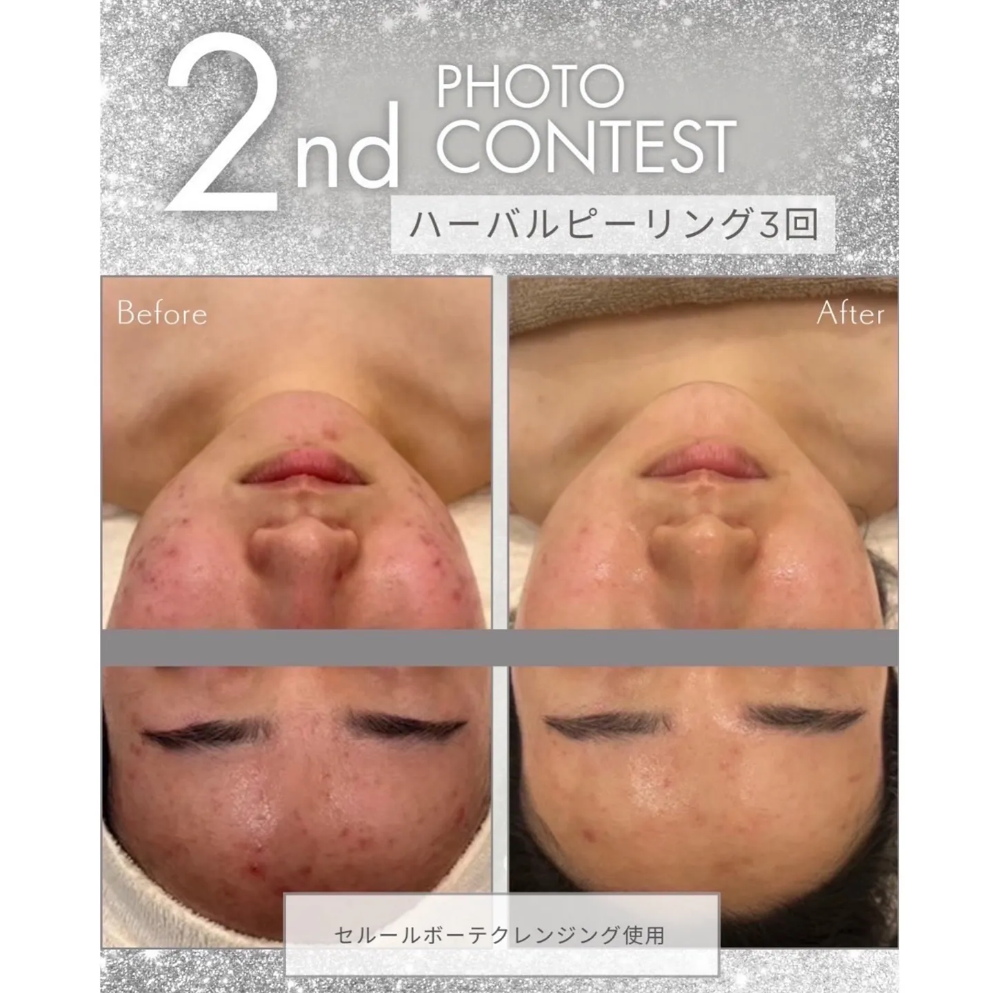 ハーバルピーリング（エンジェルではハーブピーリングと言ってま...